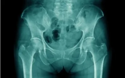 7 Misunderstood Facts About Hip Replacement Surgery