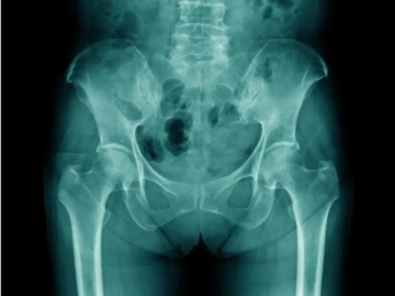 top-7-myths-about-hip-replacement-surgery-dr-pankaj