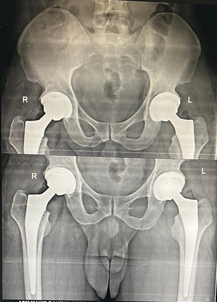 Hip replacement surgery in delhi