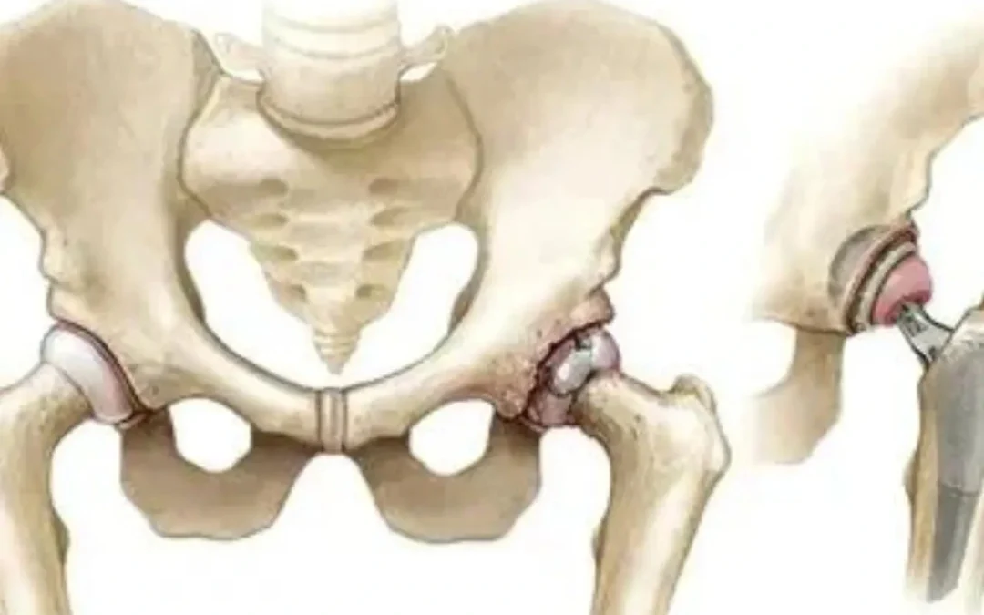 Questions and Answers About Hip Replacement Surgery