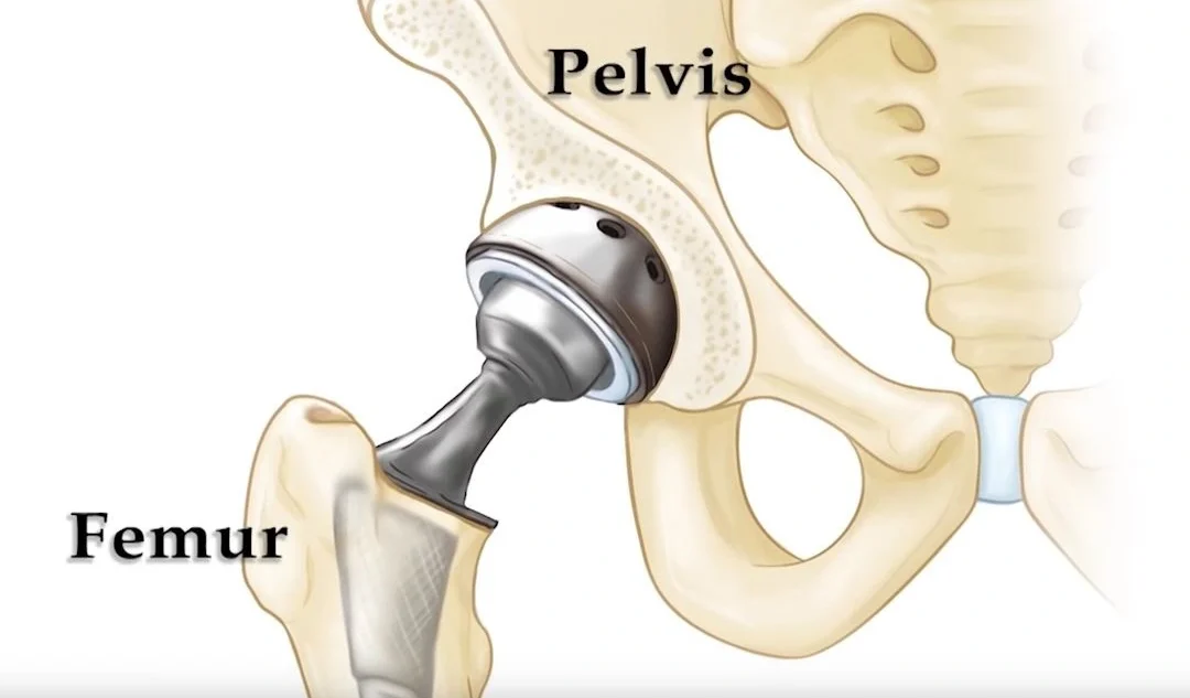 How Serious is Hip Replacement Surgery?