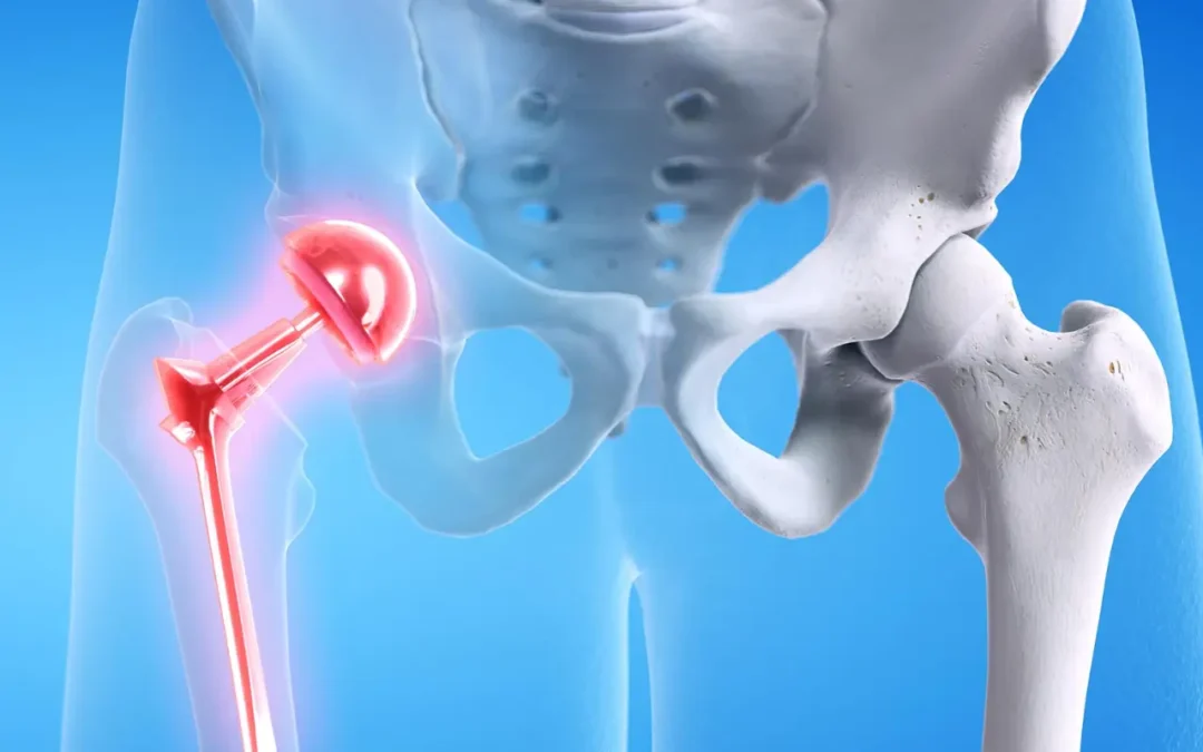 What are risks of delaying hip replacement surgery ?