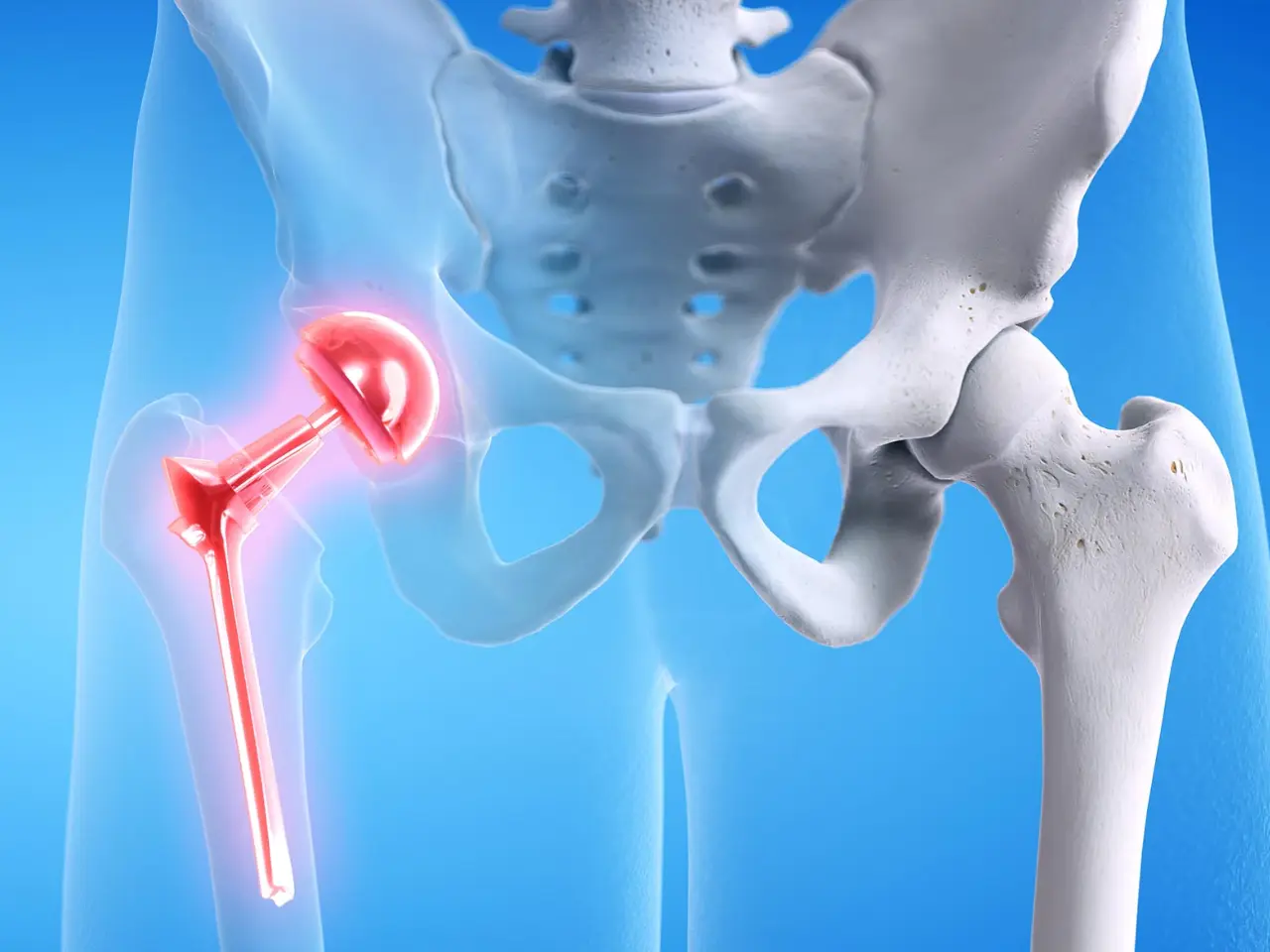 what-are-the-risks-of-delaying-hip-replacement-surgery