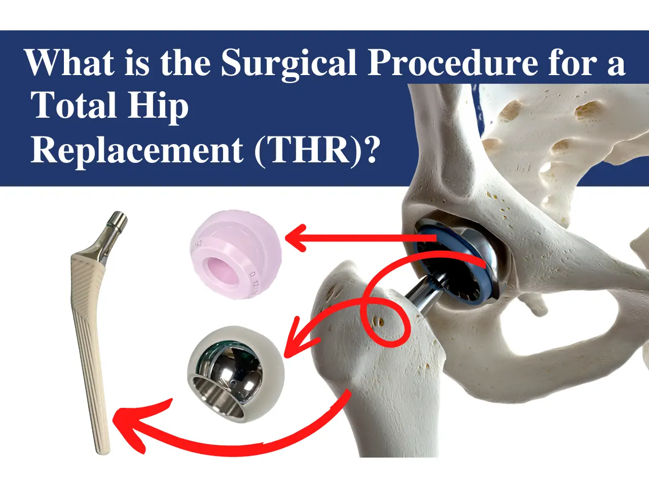 What is Total Hip Replacement Surgical Procedure?