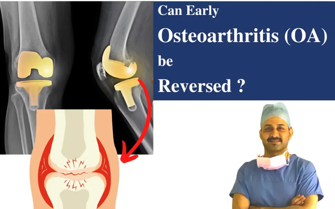 Can early osteoarthritis (OA) be reversed ?