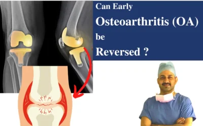 Can early osteoarthritis (OA) be reversed ?